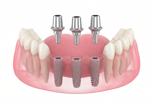 Detailed 3D Dental Implant System Illustration Showing Titanium Implants and Abutments in Lower Jaw Model for Prosthetic Dentistry Education