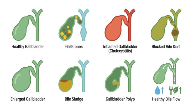 Medical illustration of gallbladder conditions, showing healthy organ, gallstones, inflammation, bile duct blockage, sludge, and healthy bile flow