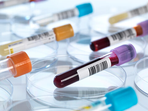 Human blood and other medical samples in petri dishes