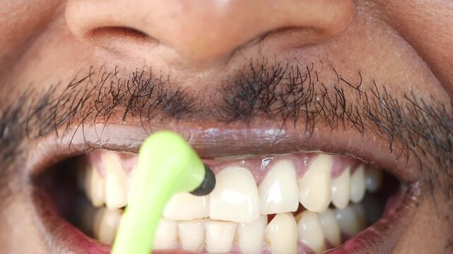 A man's mouth is seen in a close-up shot as a dentist performs a routine scaling with a small, rotating tool, focusing on the front teeth to remove plaque and stains