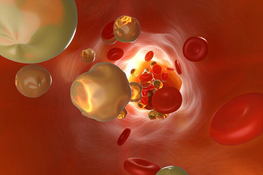 Three dimensional render of artery clogged by cholesterol