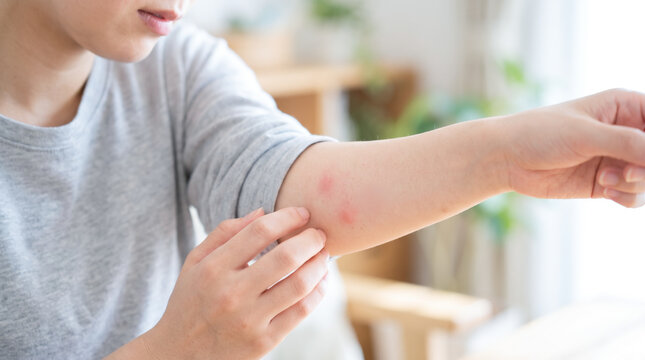 女性の腕にできた虫刺され 肌の赤みや腫れ・かゆみに悩む大人のスキンケアイメージ