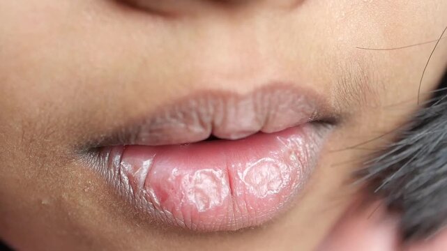 Close up of lips showing dryness and chapped skin texture with a soft focus background