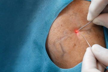 Fototapeta premium Endovenous Laser Ablation Procedure for Varicose Veins