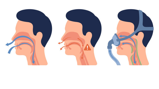 Cpap Ico Cpap Icon Images – Browse 460 Stock Photos, Vectors, and Video | Adobe ...