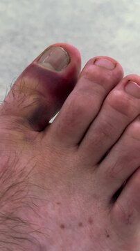 Close-up of injured foot showing bruised toe with visible swelling and discoloration, highlighting the progression of injury assessment in a neutral indoor setting