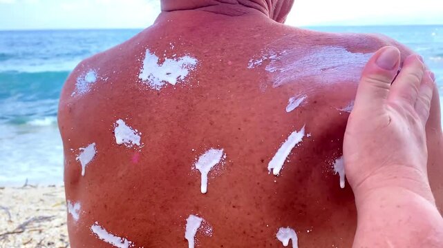 Woman applying sunscreen spf cream lotion on man's back on sea beach.Summer skincare,sun protection,sunburn treatment and health.Traveling,tropical vacation