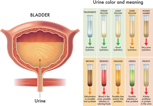 Medical diagram of urine color and meaning.