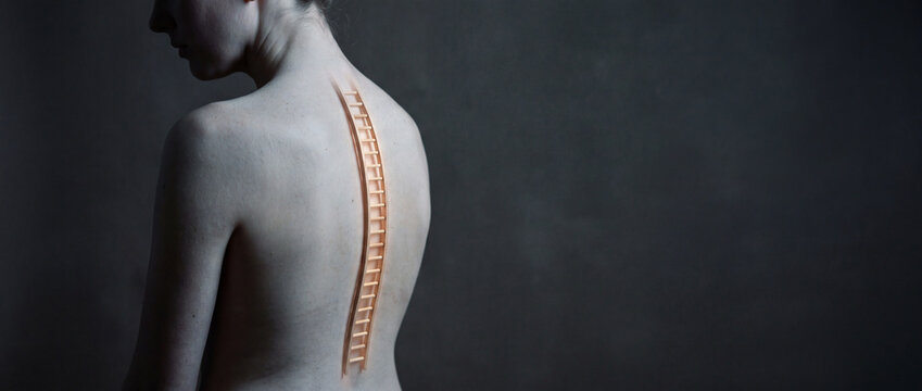 Surreal woman with ladder spine on bare back symbolizing pain, healing, medical concept and vulnerability
