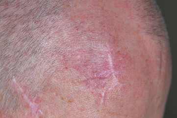 Fototapeta premium Close-up of a scalp with short hair and multiple visible scars on the skin
