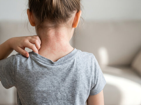 Child scratching an itchy red rash on the back of the neck, showing skin irritation, allergy, eczema, dermatitis, heat rash, or sensitive skin symptoms at home.