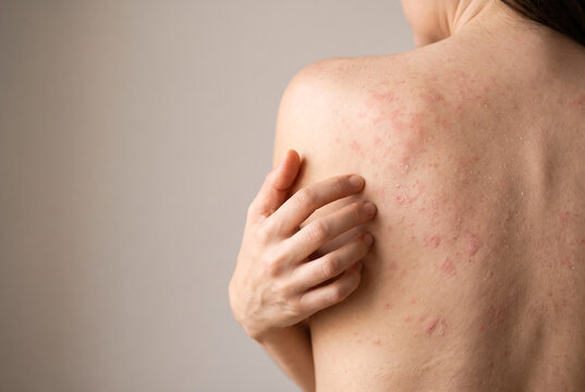 Woman scratching an itchy red rash on her upper back and shoulder, showing irritated skin, allergy, eczema, dermatitis, inflammation, or possible insect bites.