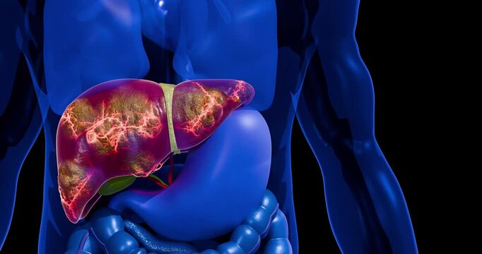 Human Liver Showing Fat Accumulation and Cancer Development with Tumor Network Expansion, Angiogenesis, Cellular Proliferation, and Disease Progression 3D Rendering
