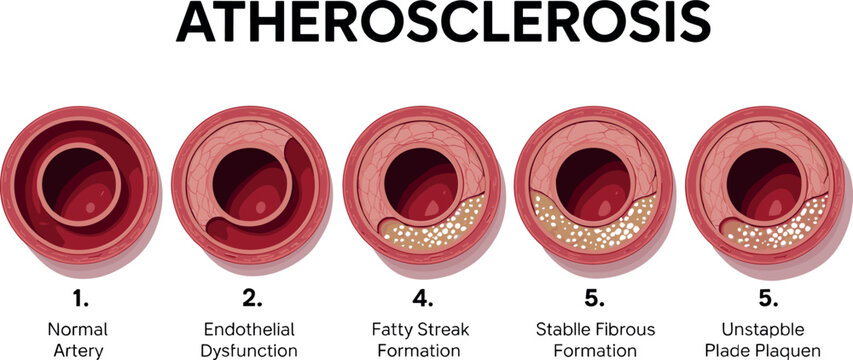 Atherosclerosis stages medical infographic showing artery disease progression with plaque and cholesterol buildup vector illustration on white