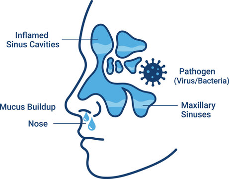 Medical Illustration of Human Sinus Infection with Inflamed Cavities and Mucus BuildupMedical Illustration of Human Sinus Infection with Inflamed Cavities and Mucus Buildup