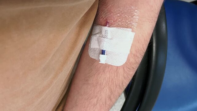 Close up handheld top-down view of intravenous cannula in man's arm