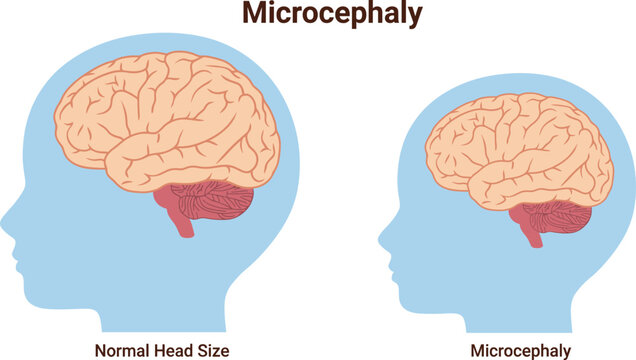 Microcephaly Medical Infographic Vector Comparing Normal Brain Development and Microcephaly Brain Size for Neurology Pediatrics and Healthcare Education