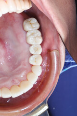Macro intraoral view of the human upper left tooth arch anatomy. Clinical dental photography of molar and premolar dentistry care during stomatology checkup in clinic hospital. © WIROT