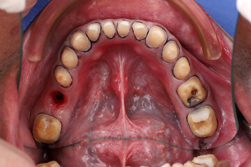Intraoral view of maxillary teeth showing crown preparation with retraction cords and fresh post extraction socket. © WIROT