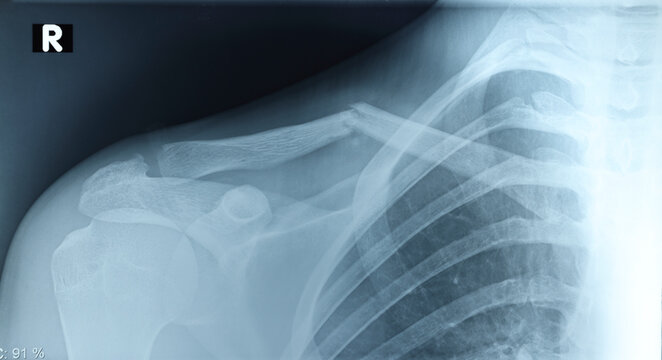 Frontal X-ray of young female cyclist showing displaced collarbone fracture after cycling fall. Broken clavicle bone injury, active competitive athlete. Pain, health care