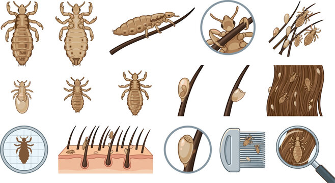 Human Head Lice and Nit Infestation Vector Icon Set Featuring Skin Follicle Cross Section Fine Removal Combs Magnifying Glass Views And Parasite Biology Elements