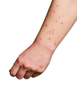  human forearm with realistic minor skin redness and insect bite marks