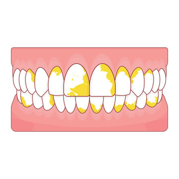 Tartar buildup on teeth illustration cartoon cute