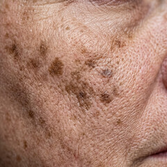 Fototapeta premium Detailed macro close up view of a mature adult person face skin affected by hyperpigmentation, dark age spots, melasma clusters and sun damage freckles.
