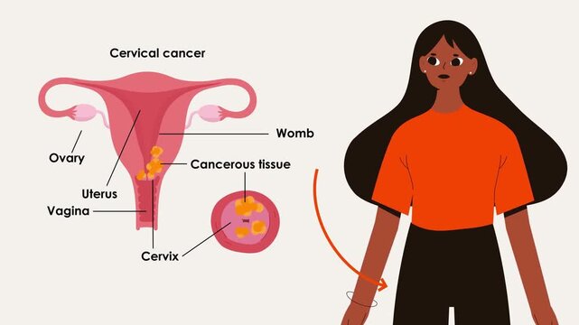 Cervical Cancer Anatomy Diagram with Woman Character 2D Animation &ndash; Medical Gynecology Education, Uterus, and Cervix Labeling Concept