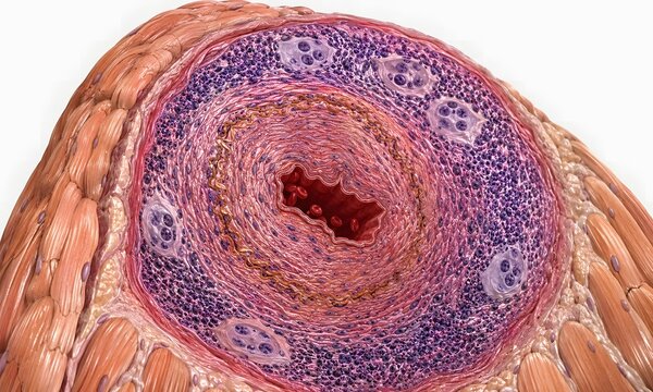 Temporal arteritis giant cell arteritis artery cross-section, rheumatology medical CGI illustration showing giant cells, granulomatous inflammation and near-occluded lumen