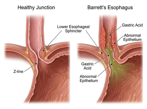 Healthy vs barrett's esophagus medical illustration isolated on white background