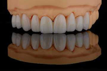 High-quality dental crowns made of zirconium for fixation to the teeth of upper jaw. © gorynvd