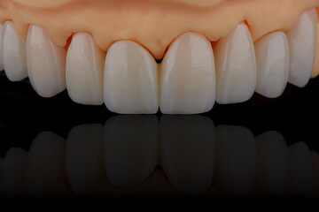 High-quality dental crowns made of zirconium for fixation to the teeth of upper jaw. © gorynvd