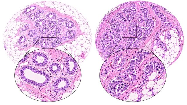 Normal Breast Histology vs Breast Cancer Histopathology H&E Microscopic Comparison Medical Atlas