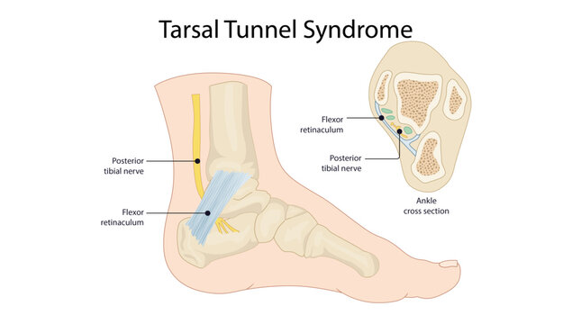 Tarsal Tunnel Syndrome, Medical illustration showing the posterior tibial nerve, flexor retinaculum, and ankle cross-sectional anatomy.
