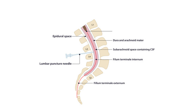 Sagittal section  of spinal cord, Medical illustration showing the sagittal spinal cord anatomy and lumbar puncture needle pathway.