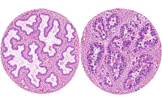 Normal Endocervix vs Endocervical Adenocarcinoma Histopathology Comparison, H&E Stained Microscopic Medical Illustration