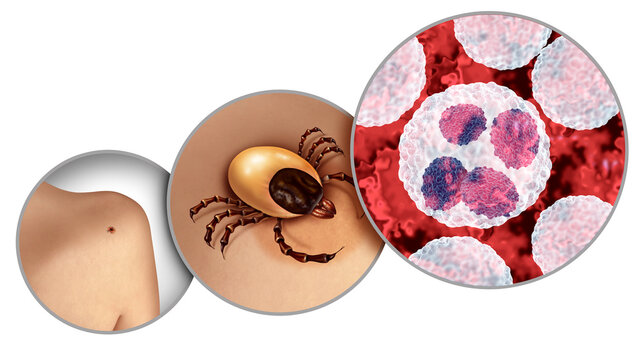 Anaplasmosis and blacklegged tick crawling on skin as a bacterial infection health danger caused by Anaplasma phagocytophilum transmitted through the bite of an infected tick, resulting in a tick born