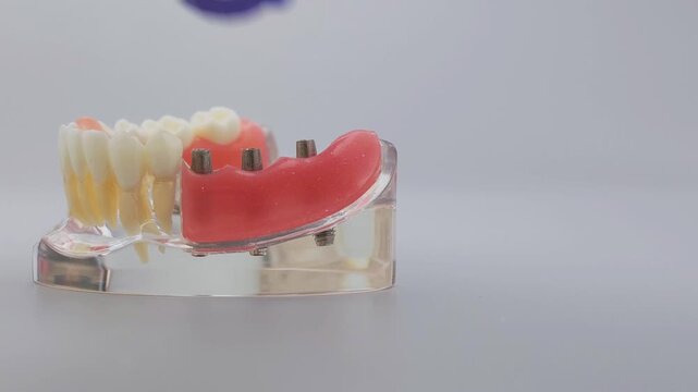 Dentist hand in blue glove removing dental bridge from implant jaw model. Dental prosthetics concept with copy space