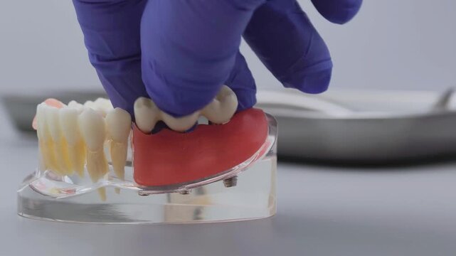 Dentist hand in blue glove placing dental bridge on implant jaw model. Clinical prosthetics concept