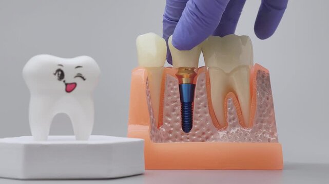 Dental Implant Placement Demonstration on Jaw Model with Gloved Hand