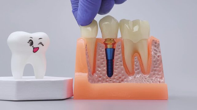 Educational concept of implantology, prosthodontics and tooth replacement.