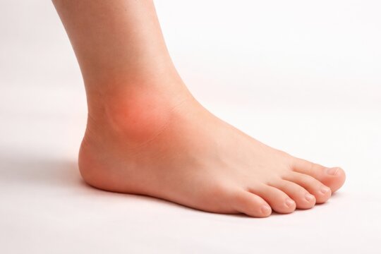 Human foot displaying swelling around the ankle, skin tone is light, set against a plain white background for clarity in medical or educational contexts