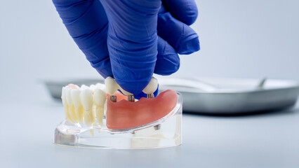 Dental implantology concept: Doctor demonstrating artificial teeth bridge installation on an...
