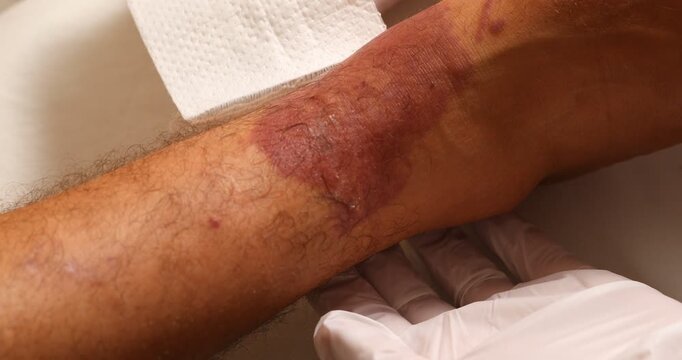  Close-up shot of a medical professional or nurse wearing white latex gloves. They carefully remove a white gauze bandage from a patient's lower leg, revealing a large, dark red skin lesion