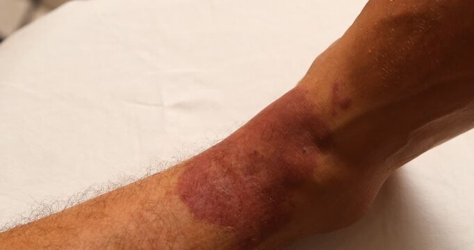 Slow camera pan revealing a severe red skin rash or allergic reaction on a patient's leg
