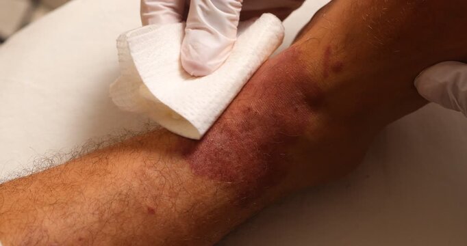 Doctor's gloved hands cleaning and wiping a severe red skin rash on a patient's leg