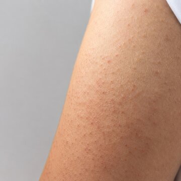 Close up of human arm skin with red bumpy texture and dry irritated patch in natural light