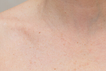 Fototapeta premium Skin with Freckles and Subtle Pigmentation on the Neck and Shoulder