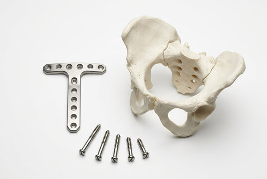 Human pelvis anatomical model with orthopedic T-shaped fixation plate and surgical screws isolated on white background. Medical implant set for trauma surgery, orthopedics and anatomy education.